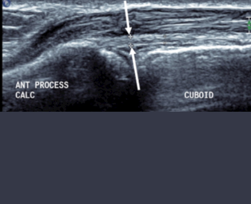 Sonographic anatomy and imaging of the dorsal supportive ligaments of the Chopart joint complex